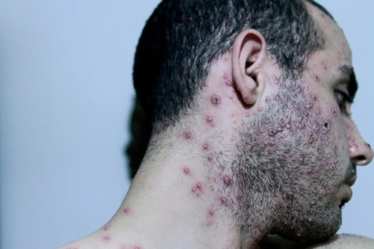 إسرائيل تسجل أول حالة إصابة بجدري القرود من النمط الفرعي 1ب لمسافر عائد من الإمارات